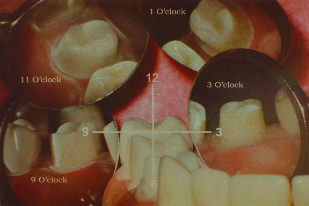 森川精密|左上后牙区的工作体位及口镜基本使用技巧 - 显微讲堂 - 3