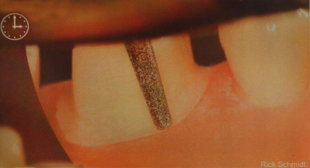 森川精密|左上后牙区的工作体位及口镜基本使用技巧 - 显微讲堂 - 21